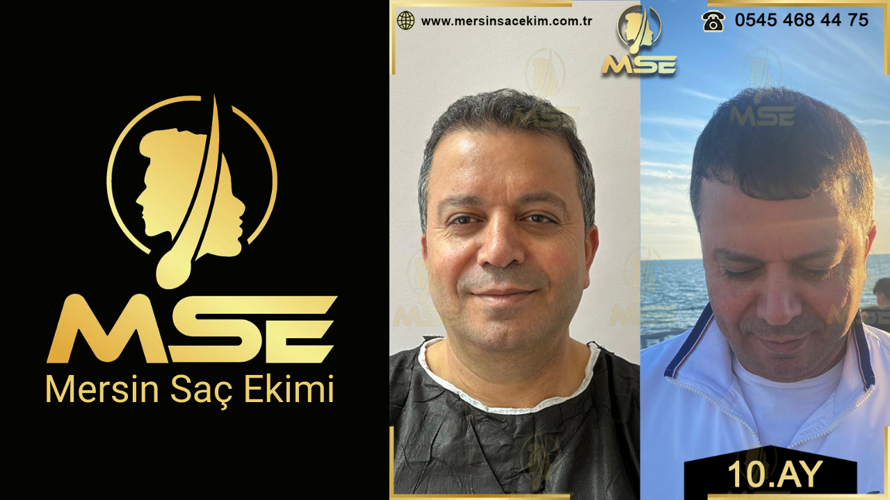 Mersin Saç Ekimi